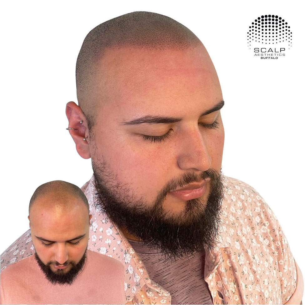 Before and after scalp micropigmentation showing improved hair density and natural coverage at Scalp Aesthetics Buffalo.