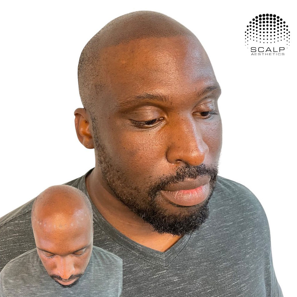 Scalp micropigmentation in buffalo result showing restored hairline in male client