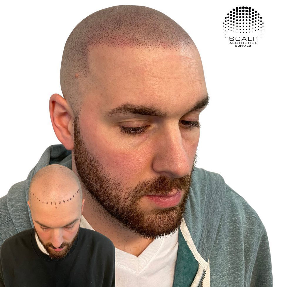 About scalp aesthetics buffalo, best scalp micropigmentation in Cheektowaga, NY