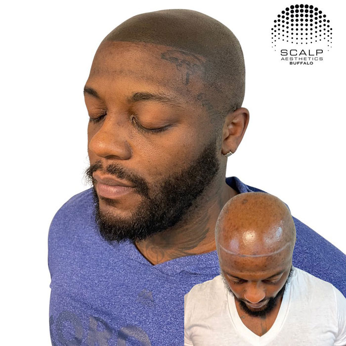 Before and after scalp micropigmentation in niagara falls results highlighting fuller-looking hair and enhanced scalp appearance.