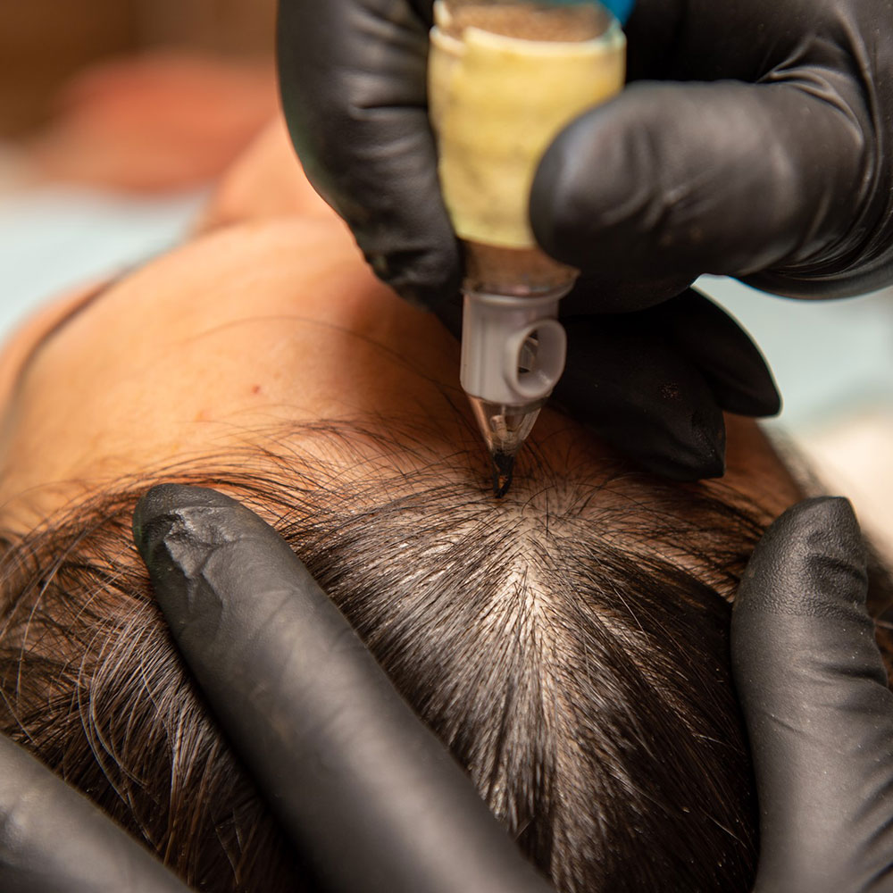 SMP for women before and after results showing enhanced hair density and natural-looking coverage at Scalp Aesthetics Buffalo.