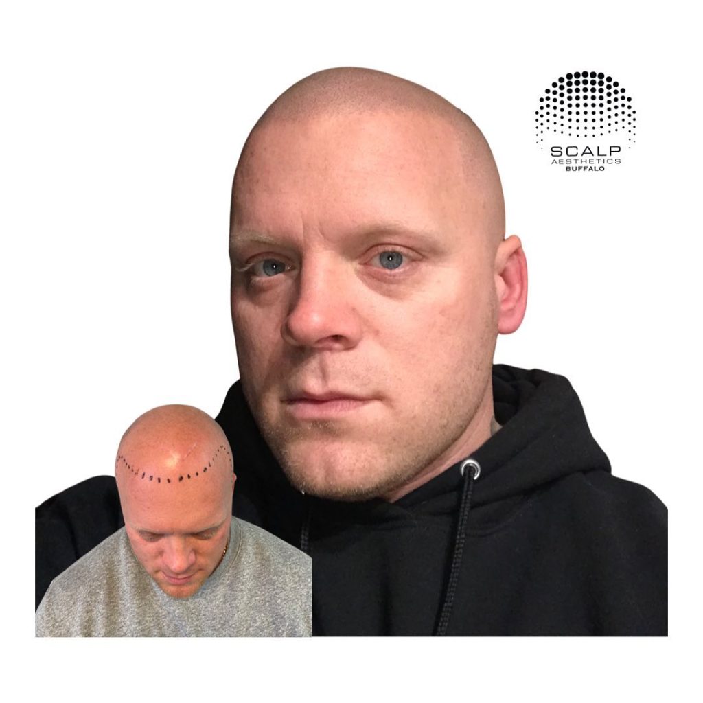 Scalp micropigmentation for alopecia creating the appearance of fuller hair