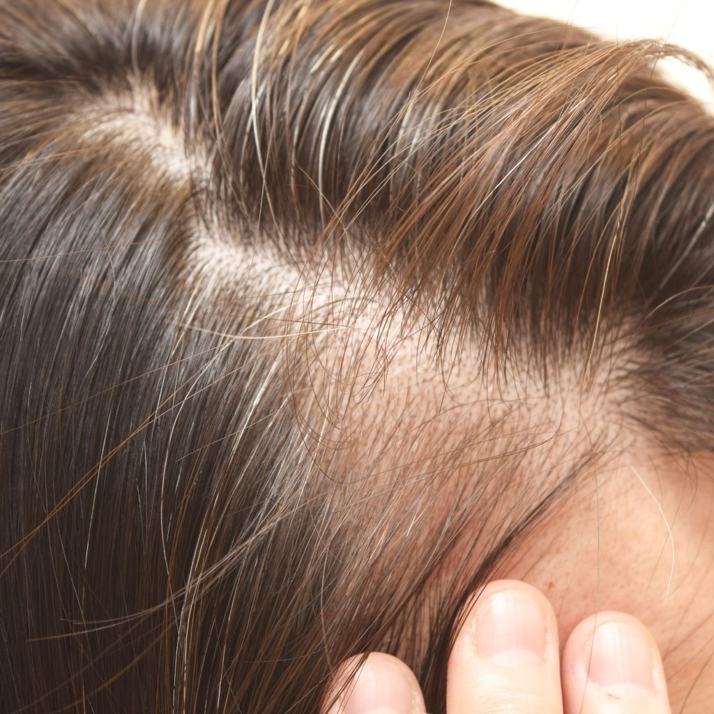 Before and after SMP for women showing improved hair density and fuller scalp appearance at Scalp Aesthetics Buffalo.