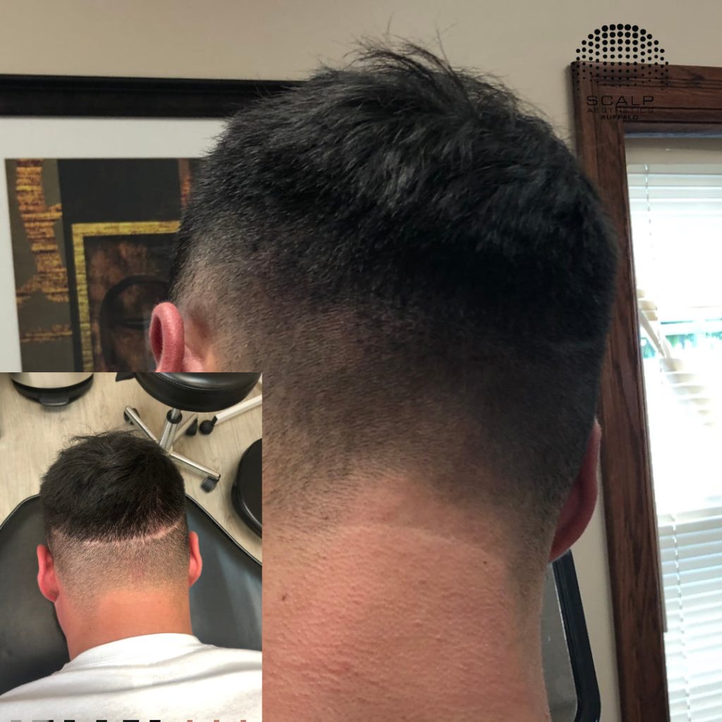 SMP for scarring for a seamless hairline